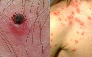 rickettsiosis