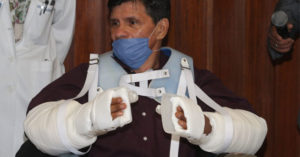 transplante de brazo