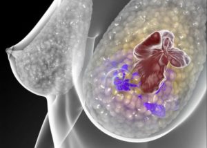 metastasis cancer