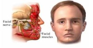 paralisis facial