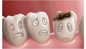caries