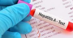 hepatitis A